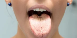 Cause e Rimedi Naturali per la Lingua Bianca