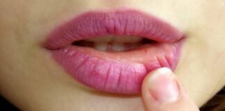 Herpes Labiale e rimedi naturali