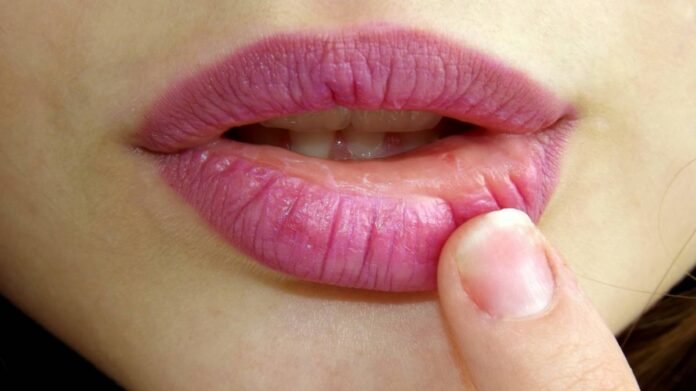 Herpes Labiale e rimedi naturali