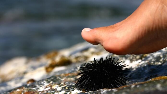 Puntura di Riccio di Mare