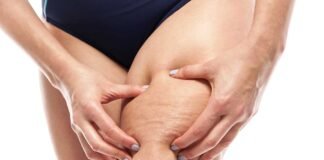 Come Contrastare la Cellulite
