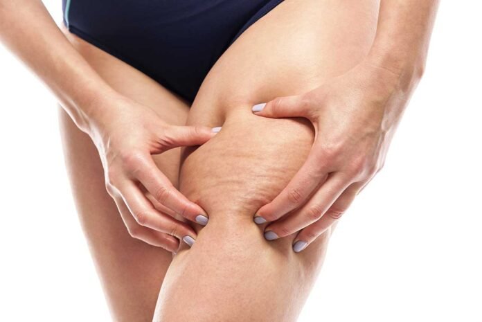 Come Contrastare la Cellulite