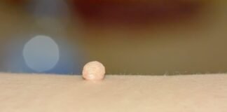 Fibromi Peduncolati
