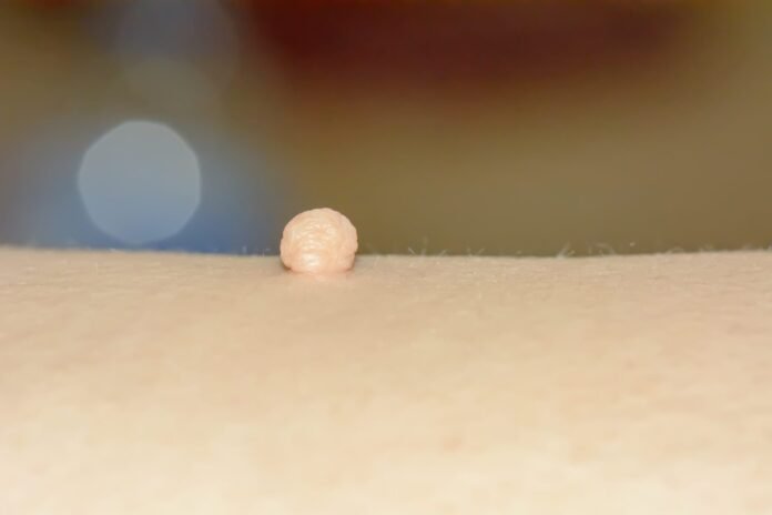 Fibromi Peduncolati