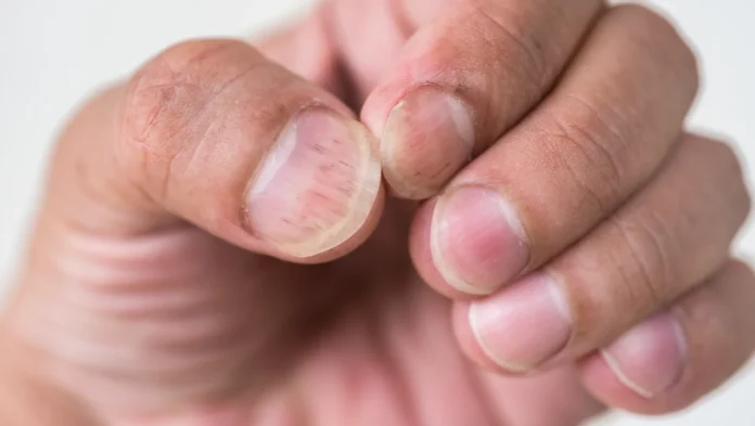 Psoriasi Ungueale
