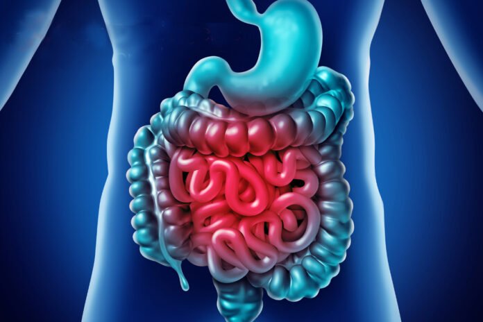 diverticolosi