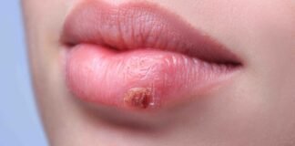 herpes labiale rimedi naturali